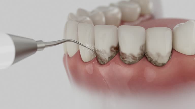 Trusted Wisdom Tooth Removal service in East Providence, RI - Dentist Open Now